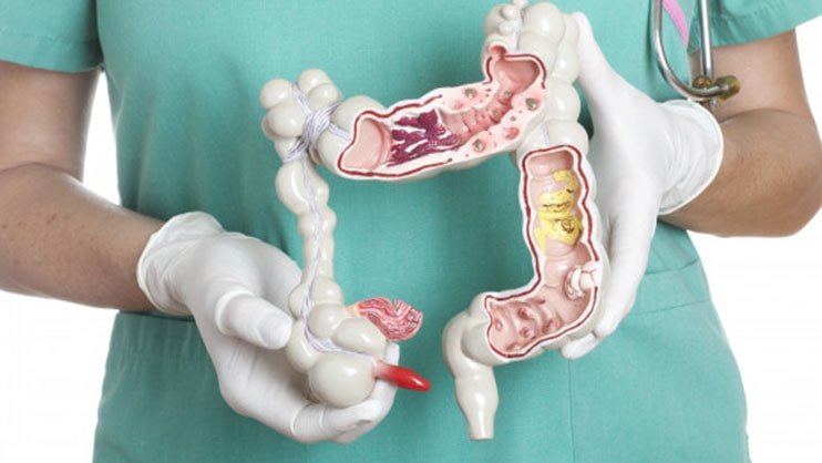 cancer specalist in gurugram for colon cancer