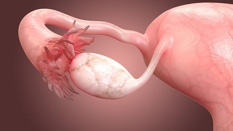 ovarian cancer specalist in gurgaon